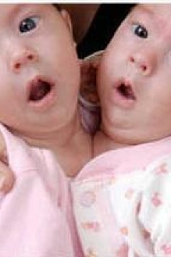 异于常人：连体人